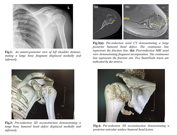 Arthroscopic Reduction and Internal Fixation of Humeral Head Osteo